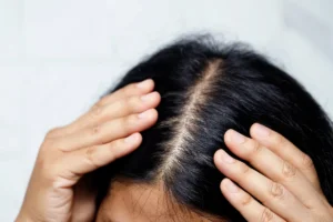 10 Natural Ways to Get Rid of Oily Scalp Naturally at Home 1 How to Get Rid of Oily Scalp at Home