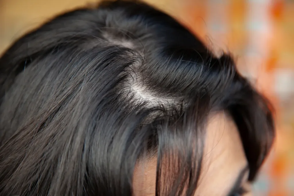 How to Reduce Hair Fall in Winter Naturally | Tips & Remedies 2 Why Does Hair Fall Increase in Winter?