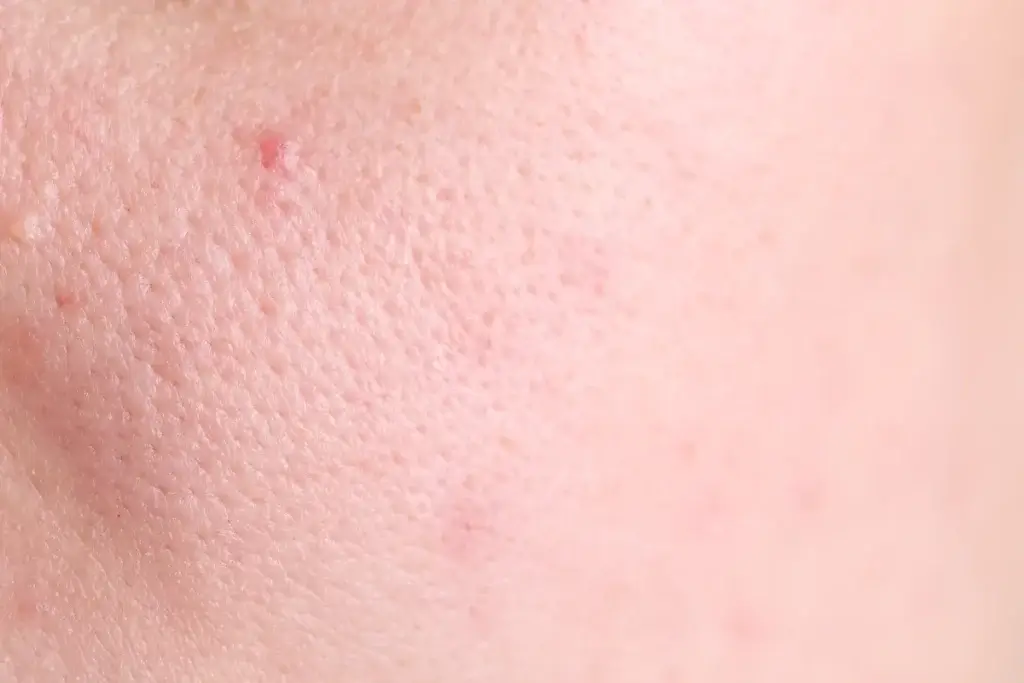 Steam to Open Pores - ओपन पोर्स क्या होते हैं?