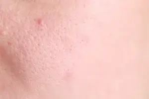 Easy Face Clean Up Steps at Home for All Skin Types 3 Steam to Open Pores
