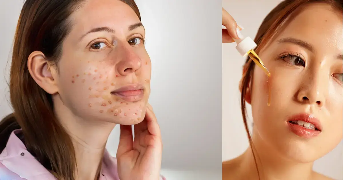 Niacinamide Uses for Skin, Face, & Acne - What Benefits & Side Effects 1 Niacinamide Uses for Skin, Face, & Acne - What Benefits & Side Effects