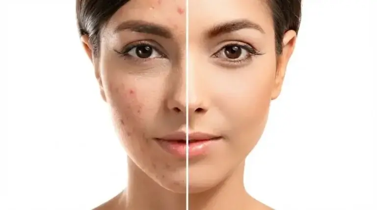 How to Use Salicylic Acid Serum for Pimples